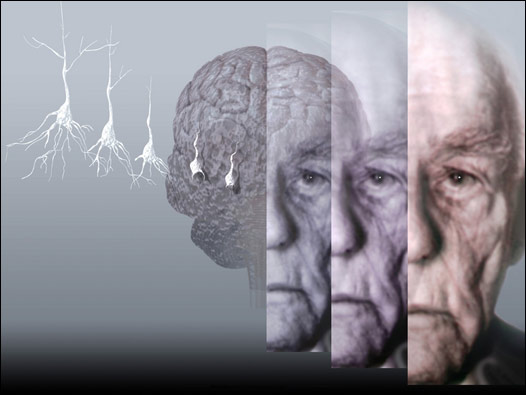 El Alzheimer es, junto con el Parkinson, la enfermedad neurodegenerativa más extendida. 